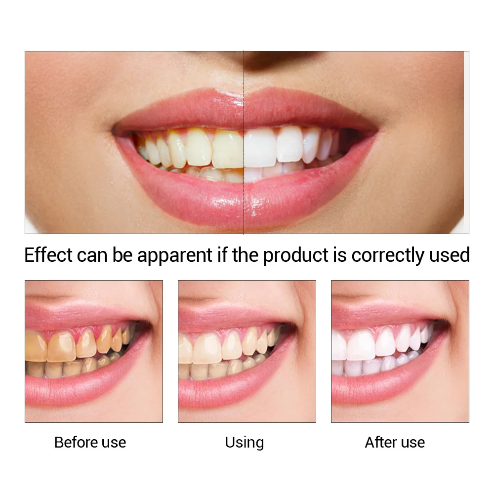 FTEENPLY отбеливание зубов быс – обзор и цена Teeth Whitening Groupon