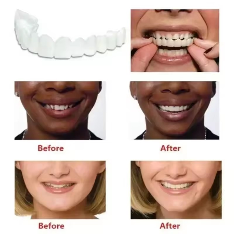 Виниры для отбеливания зубов,  – обзор и цена Teeth Whitening Veneers