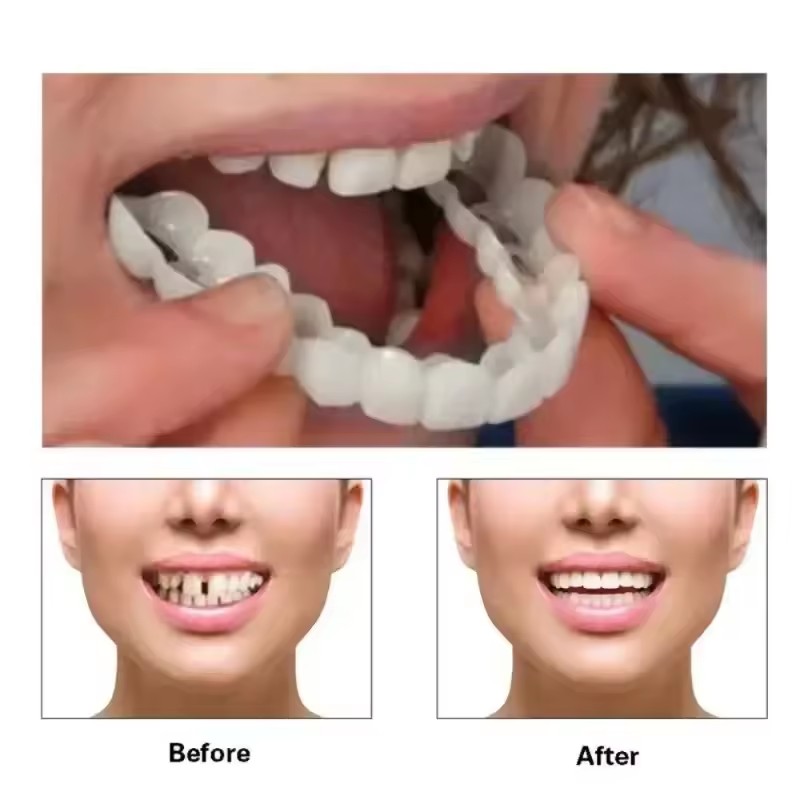 Виниры для отбеливания зубов,  – обзор и цена Teeth Whitening Veneers