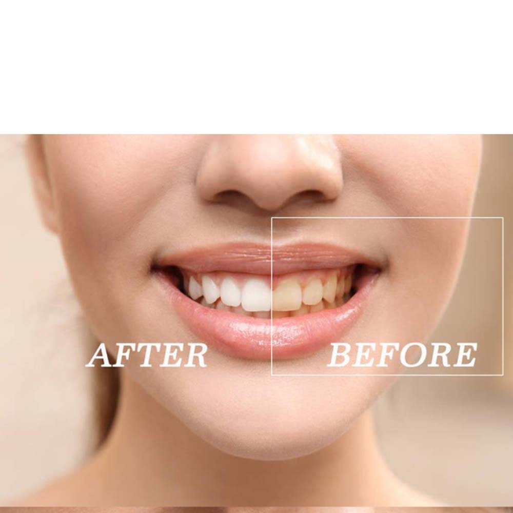 Высокое качество пероксид отбе – обзор и цена Teeth Whitening With Peroxide