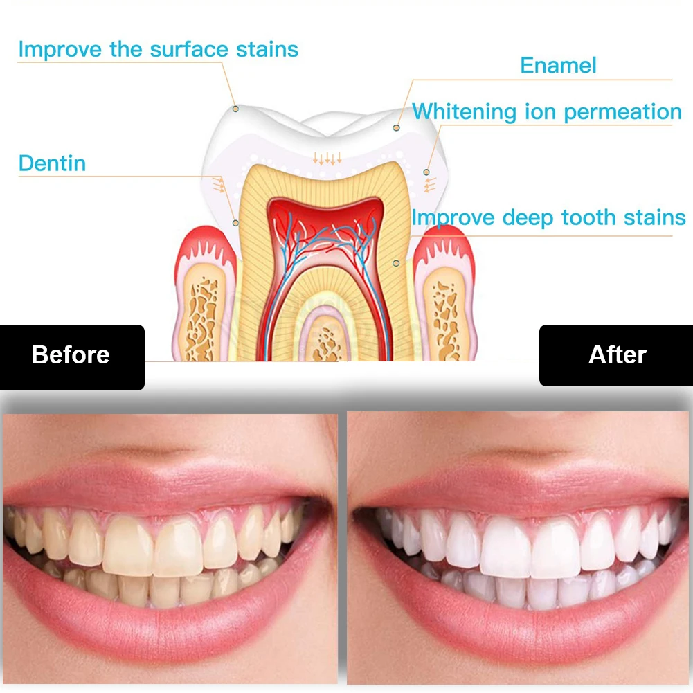 Набор для отбеливания зубов, м – обзор и цена Teeth Whitening Groupon